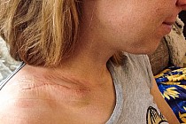 Chwila po ściągnięciu szwów i opatrunku.