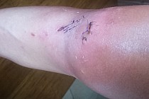 Kolano 2 dni po urazie.